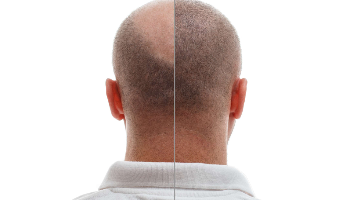 Hair Transplantation