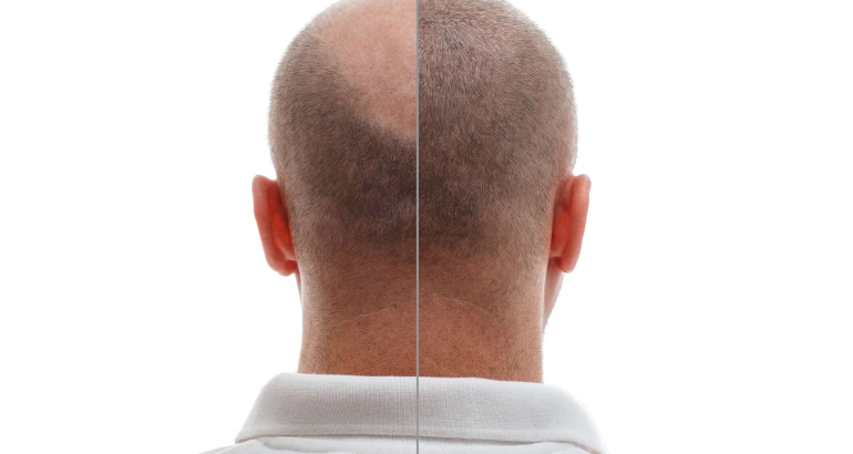 Hair Transplantation