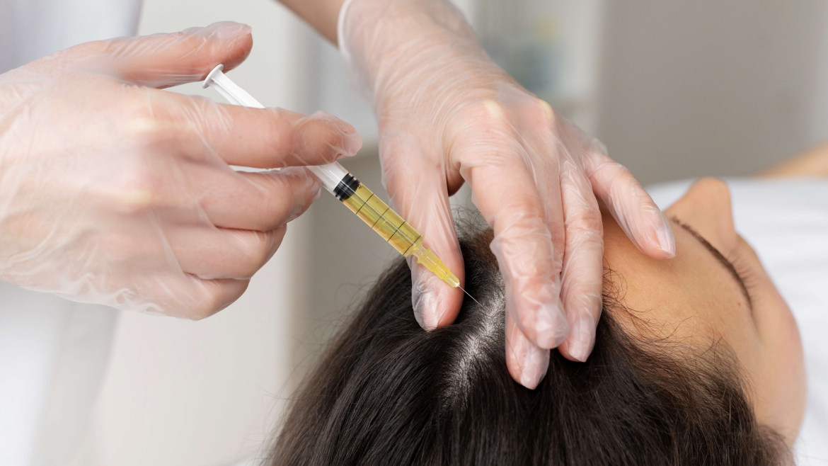 PRP therapy for hair growth