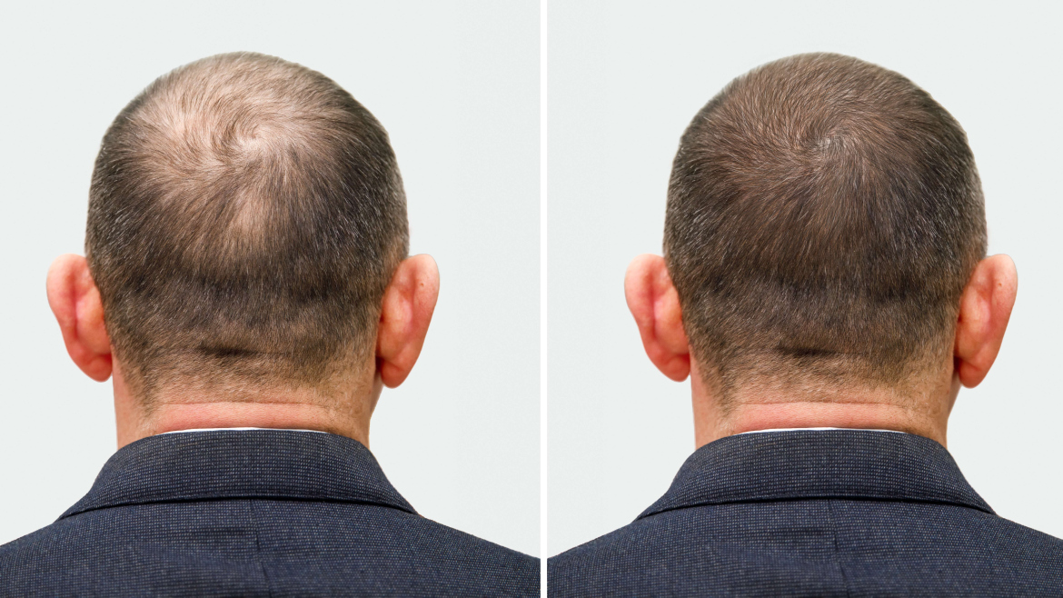 Hair transplantation